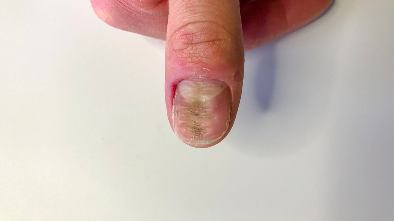 close up of nail with vertical ridge
